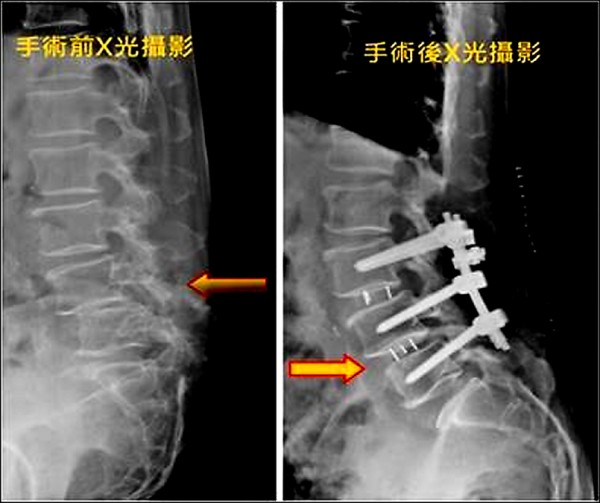 腰椎滑脫症 壓迫神經手術減壓固定 即時新聞 自由健康網