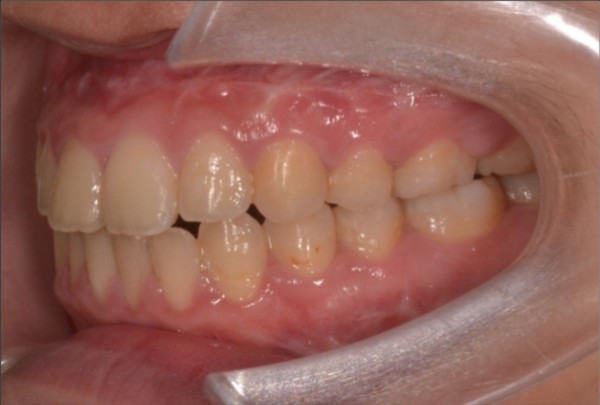 顎骨發育異常女大生戽斗講話漏風 即時新聞 自由健康網