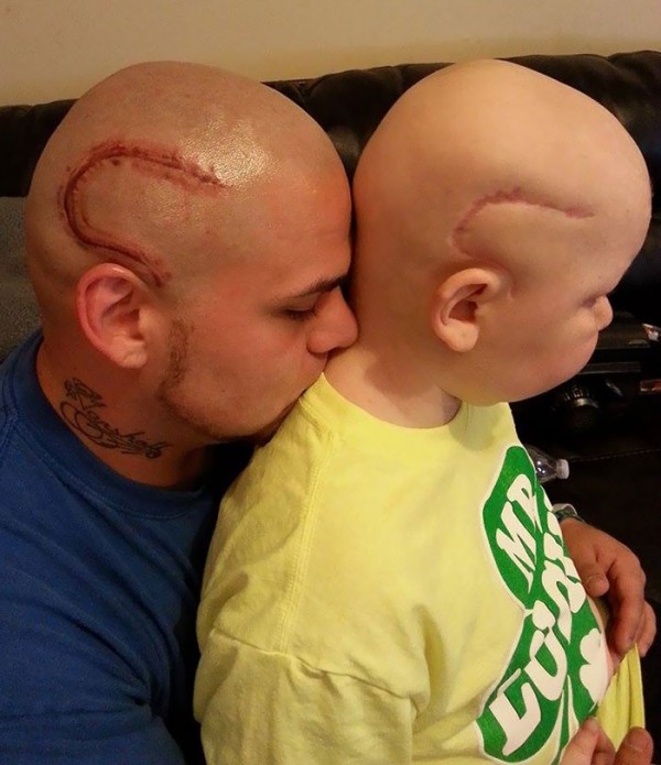 偉大的父愛！喬許為了病兒，也在自己頭上次下了相同的疤痕刺青，表達他對兒子的鼓勵。（圖片擷取自boredpanda網站）