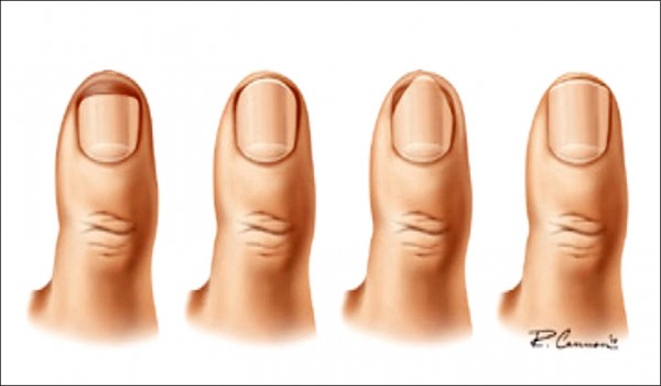 正確剪趾甲掰了凍甲 即時新聞 自由健康網