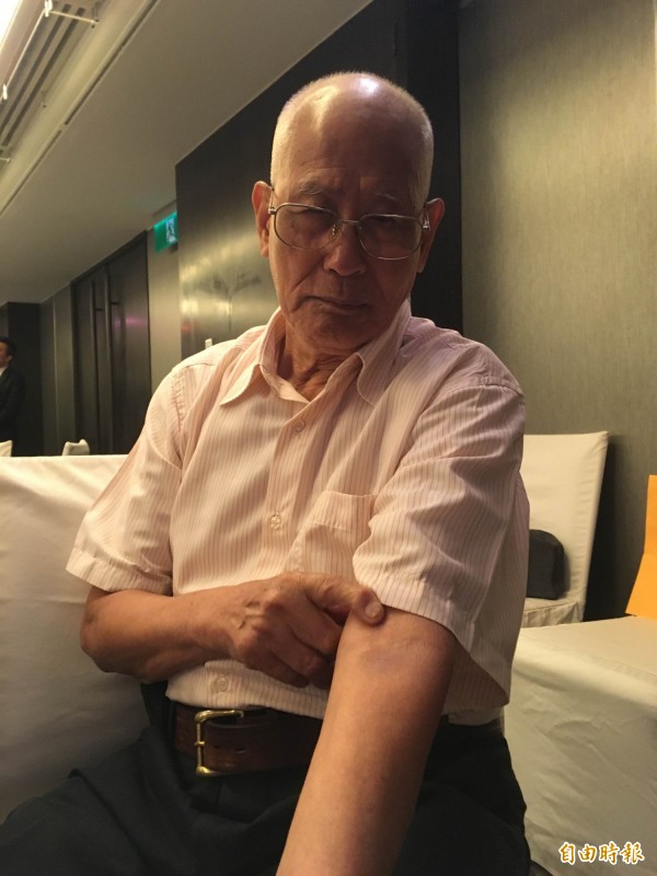 84歲的周爺爺因患有心房顫動疾病，服用抗凝血藥物多年，卻常出現出血的副作用，他手指過去出血留在腕上的瘀青。（記者林彥彤攝）