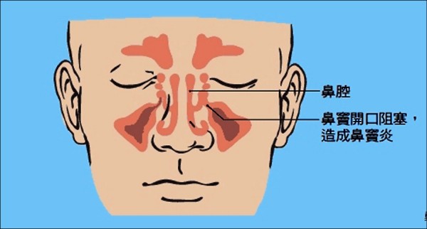 搭機就頭痛航空性鼻竇炎作怪 即時新聞 自由健康網