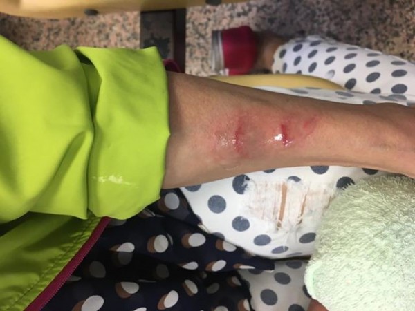民進黨台北市議員顏若芳的母親，在寧夏夜市遭到中客操控的空拍機砸傷。（圖擷自顏若芳臉書）