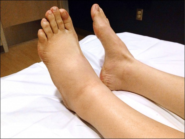 單側下肢腫脹找出原因避免栓塞危害 即時新聞 自由健康網