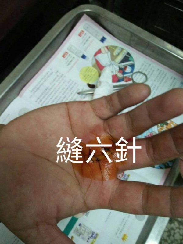 一名清潔人員在臉書上指出，同仁遭到民眾未處理妥當的玻璃物割傷掌心，縫了6針。呼籲大家丟垃圾時包妥易碎物，不要再讓這類憾事再度發生。（圖擷自爆料公社）