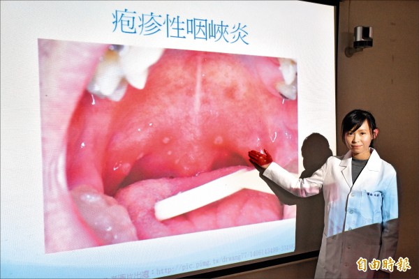 輕忽腸病毒2歲童心肌炎險送命 即時新聞 自由健康網