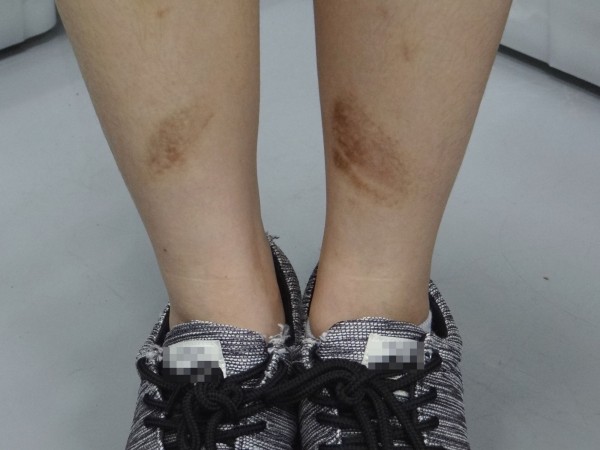 保健 身上有傷喝咖啡疤痕變黑 醫師 沒科學根據 即時新聞 自由健康網