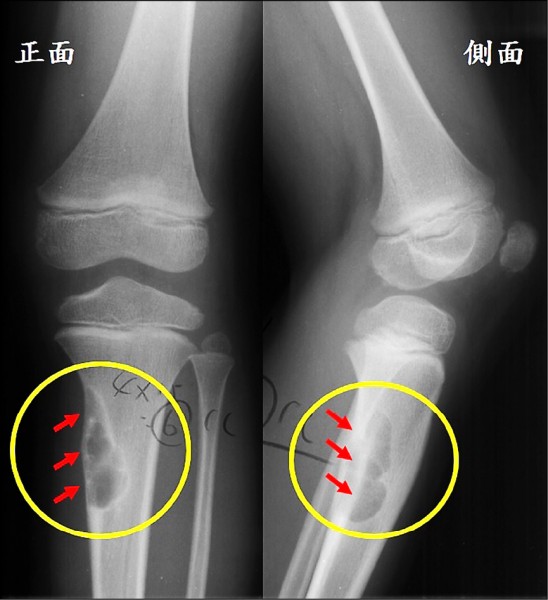 不是生長痛 幼童小腿痛竟是骨腫瘤 即時新聞 自由健康網