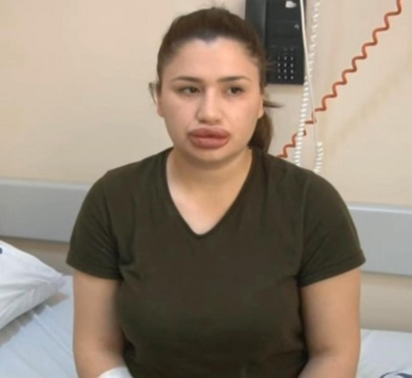 土耳其女凱莉絲因貪小便宜，使用不明填充物隆唇，雙唇有如「鑫鑫腸」般腫脹。（圖擷取自《太陽報》）