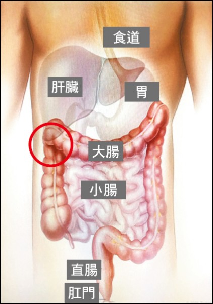 大腸癌混合2種瘤難診斷惡性度又高 即時新聞 自由健康網