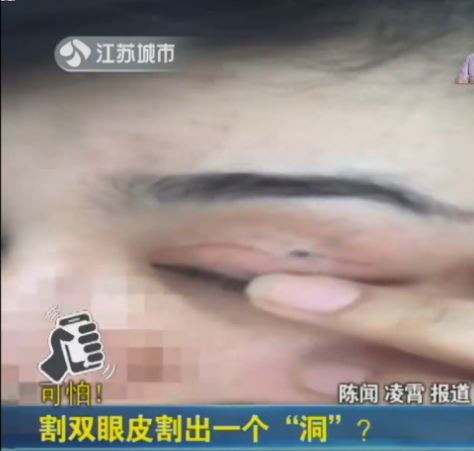 江蘇南京一名張姓女子到整形醫院割雙眼皮，術後卻發現左眼皮上出現一個洞，不僅能看到眼珠，眼淚還會從洞口流出。（圖擷取自《江蘇城市頻道》）