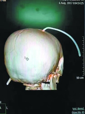 男童頭部遭鋼筋貫穿。（擷取自《新浪網》）