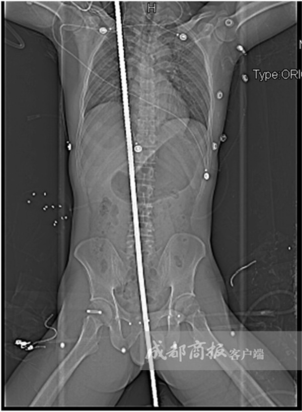 中國1名男子在工地上遭受電擊，而後墜落時不慎坐到1.2公尺長的鋼筋，在離肛門1公分附近的位置斜插進身體，直達右肩。（成都商報）