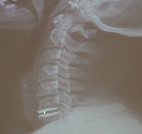 醫病 手麻痛原來是頸椎退化壓迫神經惹禍 即時新聞 自由健康網