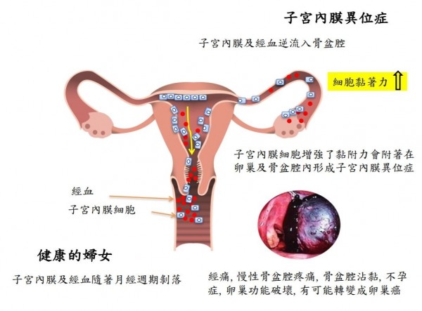 新知 治療子宮內膜異位症新藥可望10年內問世 即時新聞 自由健康網