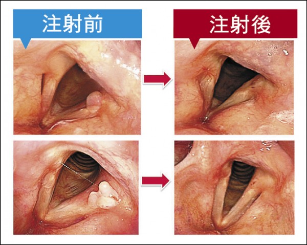 腫 肉芽