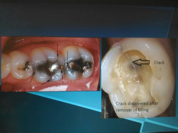 醫病 進食牙齒酸痛無力牙醫師 可能是齒裂徵兆 即時新聞 自由健康網