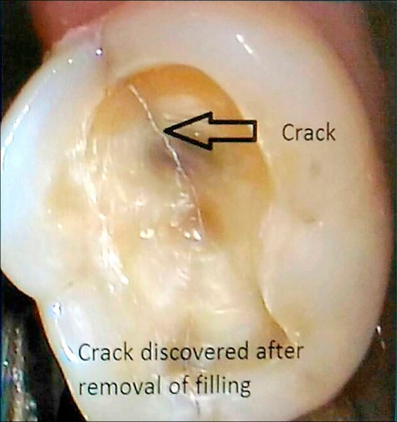 進食牙酸痛敏感疑裂齒症 即時新聞 自由健康網