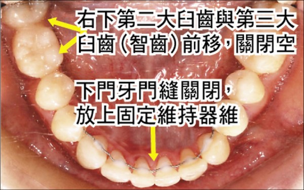 智齒往前拉臉型年紀齒況都要評量 即時新聞 自由健康網