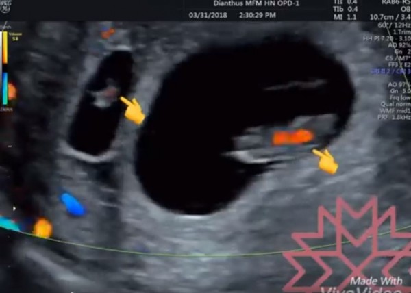 生命的奧妙 產檢喜見8週大胎兒旁多了 新鄰居 即時新聞 自由健康網