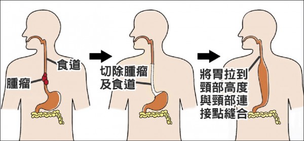 每天半瓶酒 4包菸食道癌纏身 即時新聞 自由健康網