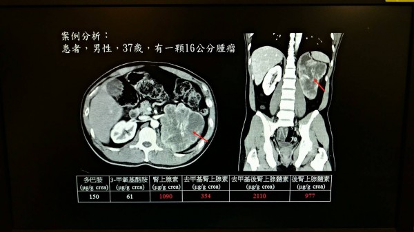 醫病 嗜鉻細胞瘤引起高血壓成醫 可以開刀治癒 即時新聞 自由健康網