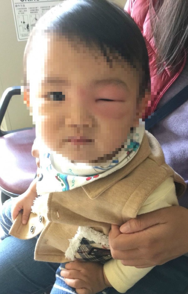 2歲簡姓男童左眼旁被蚊子叮後，昨天起床竟腫脹到眼睛睜不開，宛如「麵龜」，讓家人都嚇壞了。（記者陳建志翻攝）