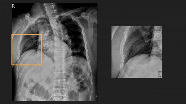 醫病 肋骨骨折連呼吸都會痛超薄骨板治療緩解 即時新聞 自由健康網