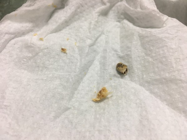 醫病 5歲就重聽 原來是耳屎太多惹禍 即時新聞 自由健康網