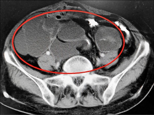 卵巢癌轉移合併腸阻塞減積 化療增加存活時間 即時新聞 自由健康網