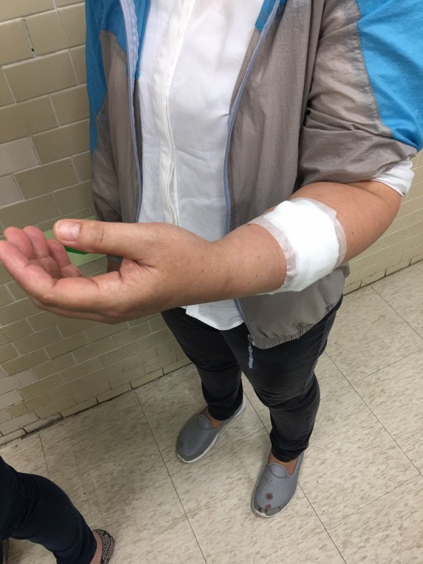 41歲的女外傭左手前臂，意外被江姓鄰居的土狗咬傷送醫。（記者陳恩惠翻攝）