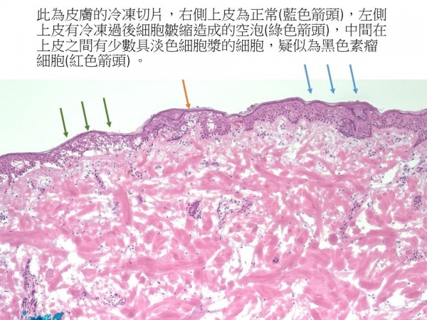 醫師臨床善用冷凍切片，三度手術成功將惡性腫瘤完全切除。（記者蔡彰盛翻攝）