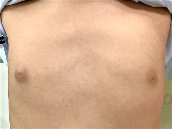 男性女乳症少年苦惱大胸部 即時新聞 自由健康網