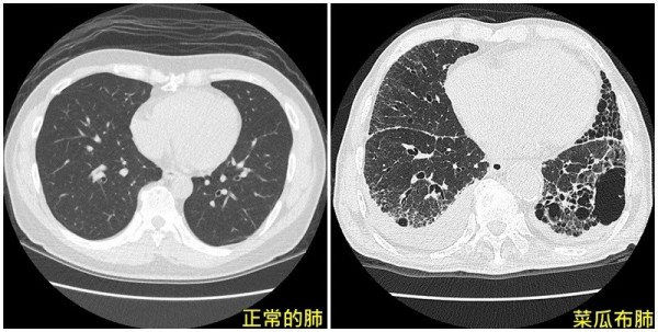 醫病 老菸槍咳不停罹阻塞性肺病合併特發性肺纖維化 即時新聞 自由健康網