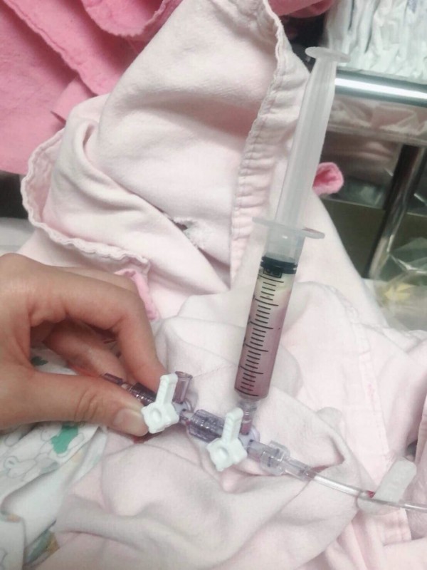 血液中三酸甘油脂超過正常值一百倍,抽出來的血液好像煉乳。(記者吳亮儀翻攝) 血液中三酸甘油脂超過正常值一百倍,抽出來的血液好像煉乳。(記者吳亮儀翻攝)