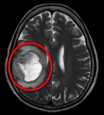 醫病 她突然昏眩癱瘓竟是 惡性膠質母細胞瘤 釀禍 生活 自由時報電子報