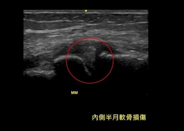 醫病 肩膀 膝蓋疼痛難動彈 增生療法 助恢復 即時新聞 自由健康網