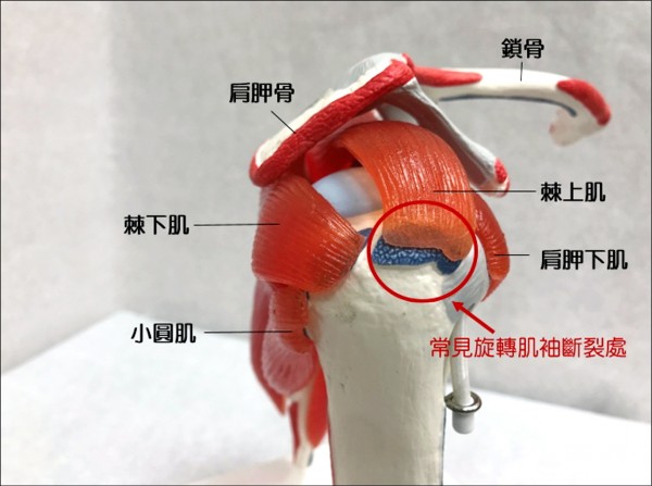 沒骨折卻無法抬肩恐是旋轉肌袖斷裂 即時新聞 自由健康網