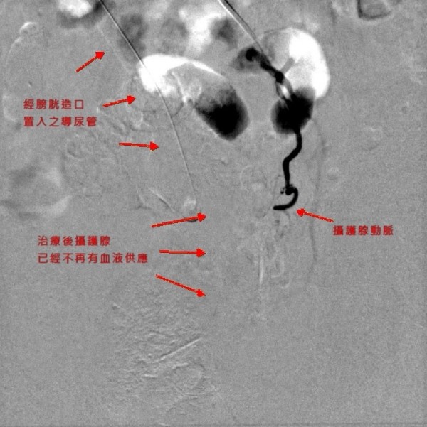 9旬翁攝護腺肥大難解尿 攝護腺動脈栓塞術 助通樂 即時新聞 自由健康網