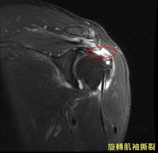 醫病 6旬婦肩痛以為50肩竟是旋轉肌袖撕裂作祟 即時新聞 自由健康網