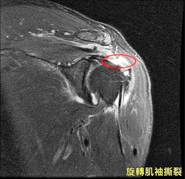 旋轉肌袖撕裂多需手術修復 即時新聞 自由健康網