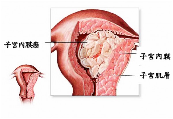 月經遲遲不來40歲胖姊罹子宮內膜癌 即時新聞 自由健康網