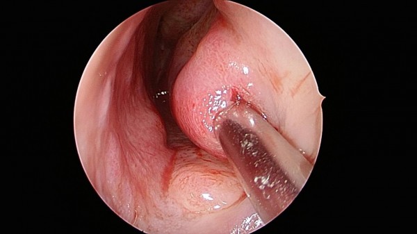 醫病 鼻過敏20年他下鼻甲肥厚 睡眠呼吸中止 即時新聞 自由健康網