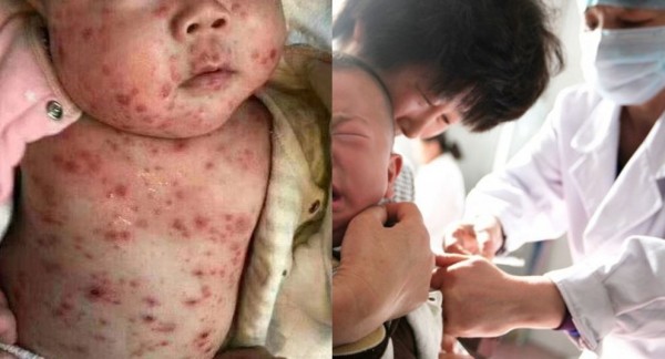 中國江蘇兒童接種過期疫苗，出現全身紅疹引發家長不滿。（左圖擷取自推特，右圖法新社，本報合成）