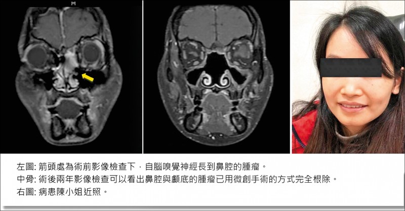 取代開腦 鼻腔內視鏡切除惡性腫瘤 即時新聞 自由健康網