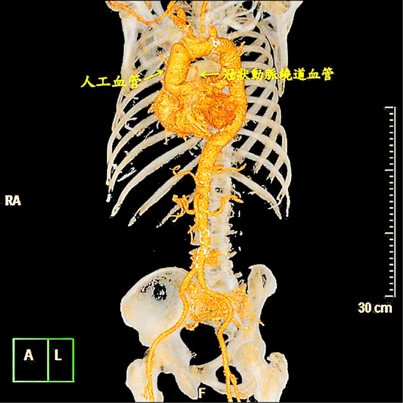 急性心肌梗塞合併主動脈剝離緊急置換人工血管保命 即時新聞 自由健康網