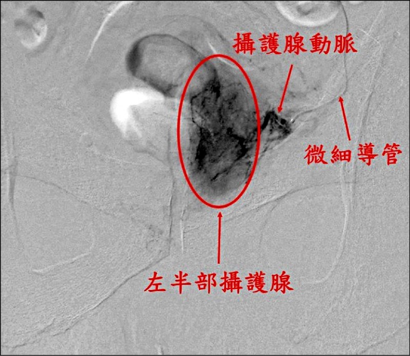 新攝護腺動脈栓塞術傷口小恢復快 即時新聞 自由健康網