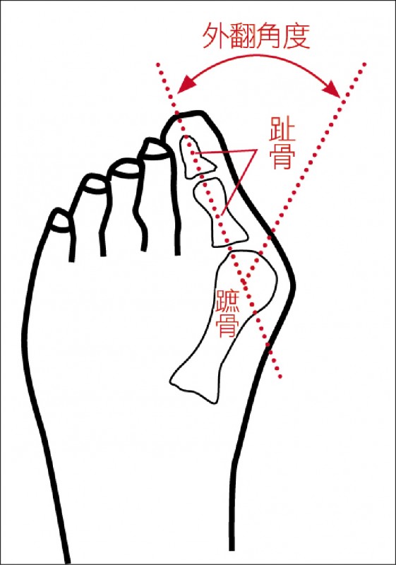 生活撇步 防趾惡化 拇趾外翻自己救 生活週報 自由時報電子報