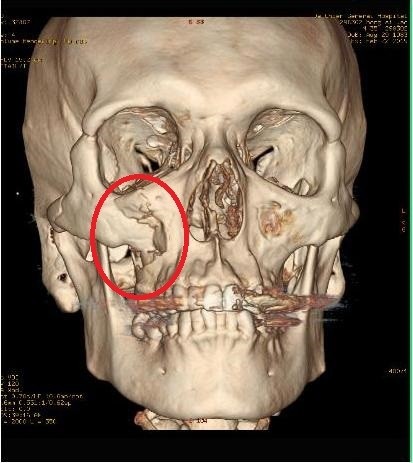 一失足臉骨折手術復位還 真面目 即時新聞 自由健康網