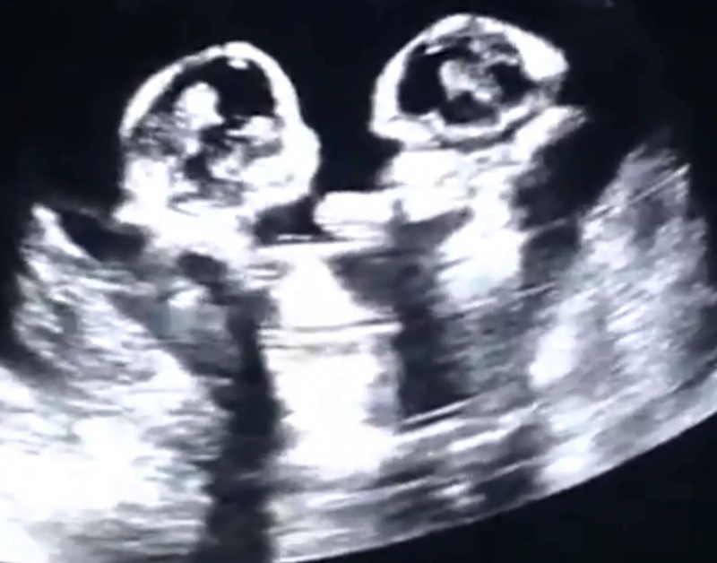 罕見 雙胞胎女嬰在子宮內打架全被超音波照下來了 國際 自由時報電子報
